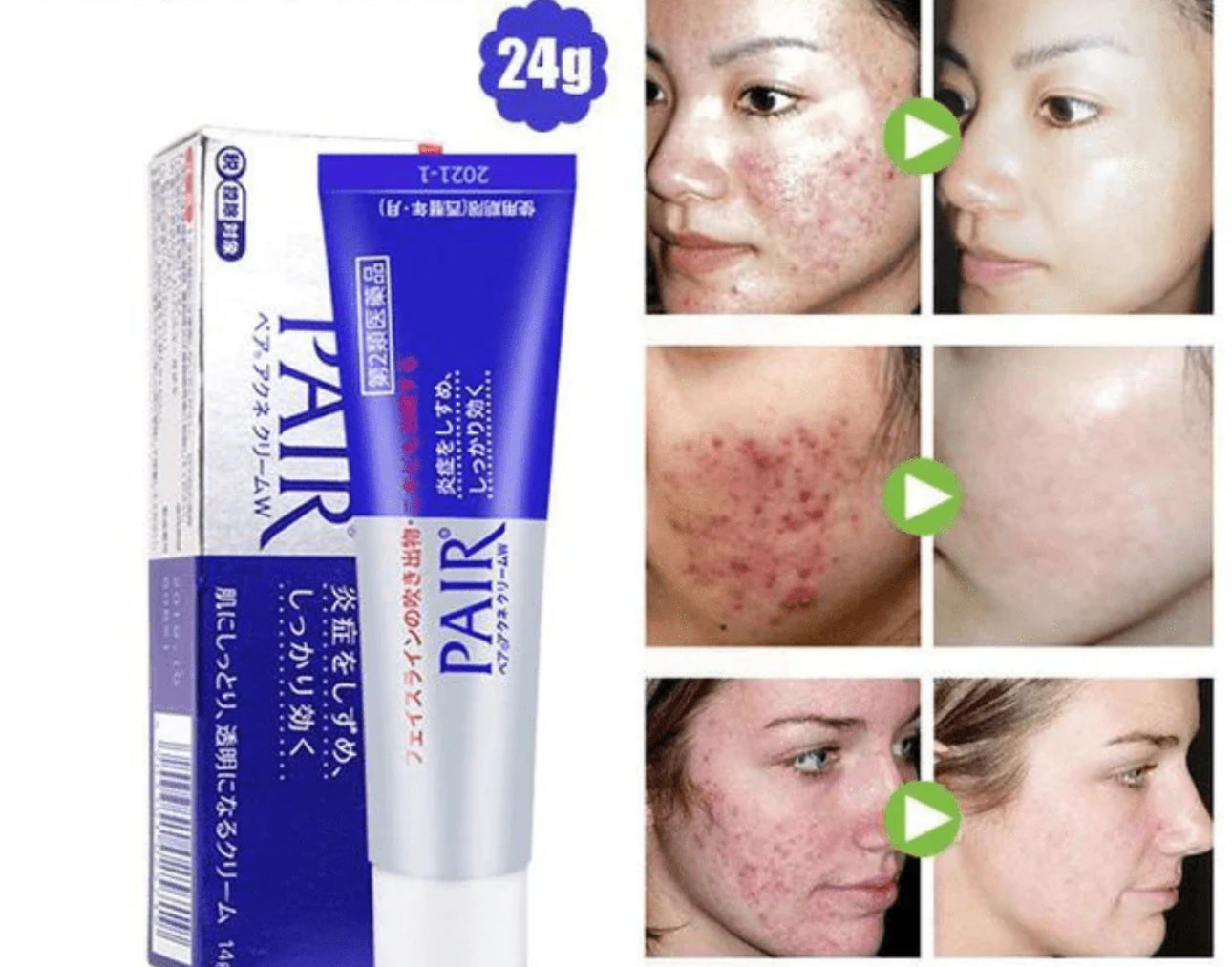 PAIR ACNE CREAM W